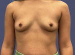 Breast Augmentation 6 Before